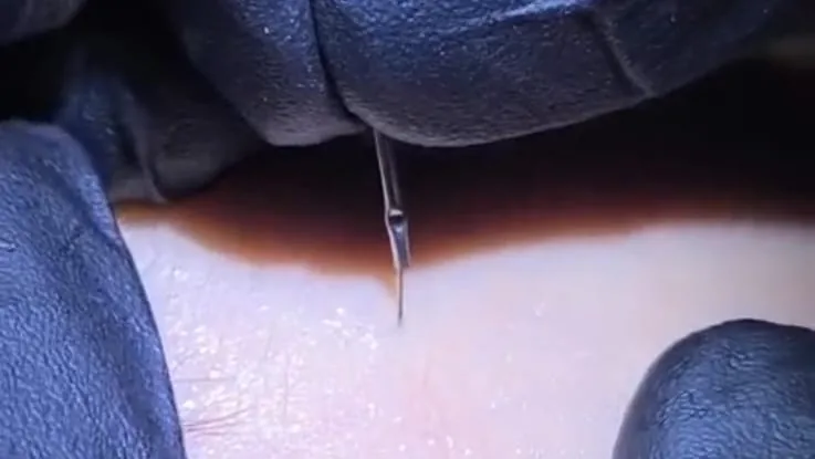 Extração de comedão com microagulha estéril